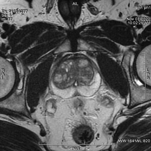 IRM DE LA PROSTATE